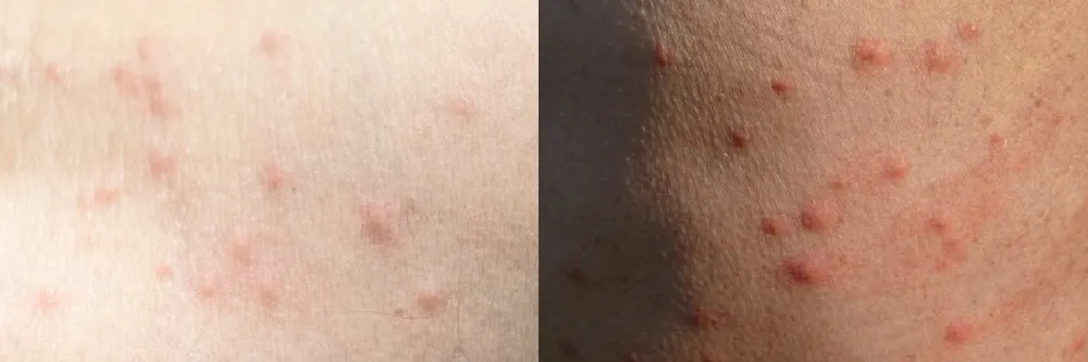 bed bug bites vs flea bites